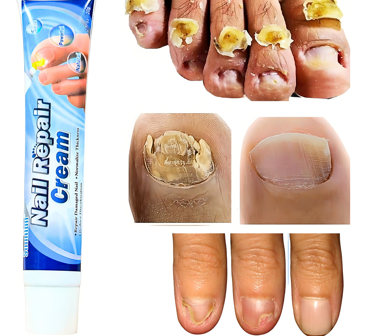 acabar com fungos nas unhas rapidamente