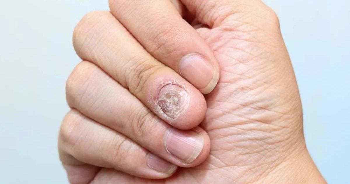 acabar com fungos nas unhas rapidamente