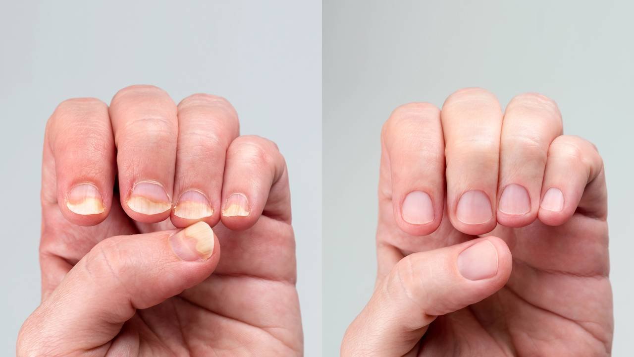 1. Como a Terbinafina age contra fungos nas unhas?
2. Guia completo sobre o uso de Loceryl para micose.
3. Terapia a laser: a nova fronteira no tratamento de fungos nas unhas.
4. Remédios caseiros para fungos nas unhas: o que realmente funciona?
5. Higiene e prevenção: como evitar a reinfecção por fungos nas unhas.
