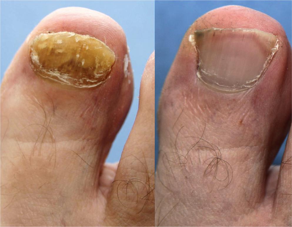 acabar com fungos nas unhas rapidamente