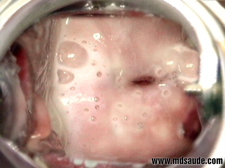 corrimento líquido água em grande quantidade