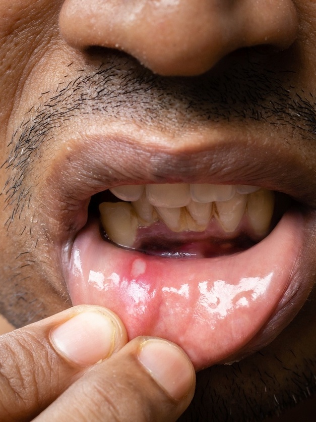 5 Remédios Caseiros Eficazes para Aliviar a Dor de Afta