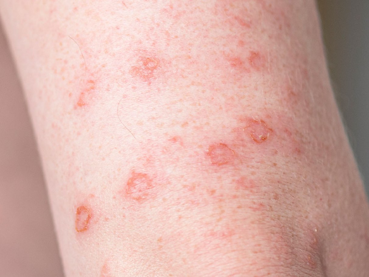 é a ferida da sífilis feminina