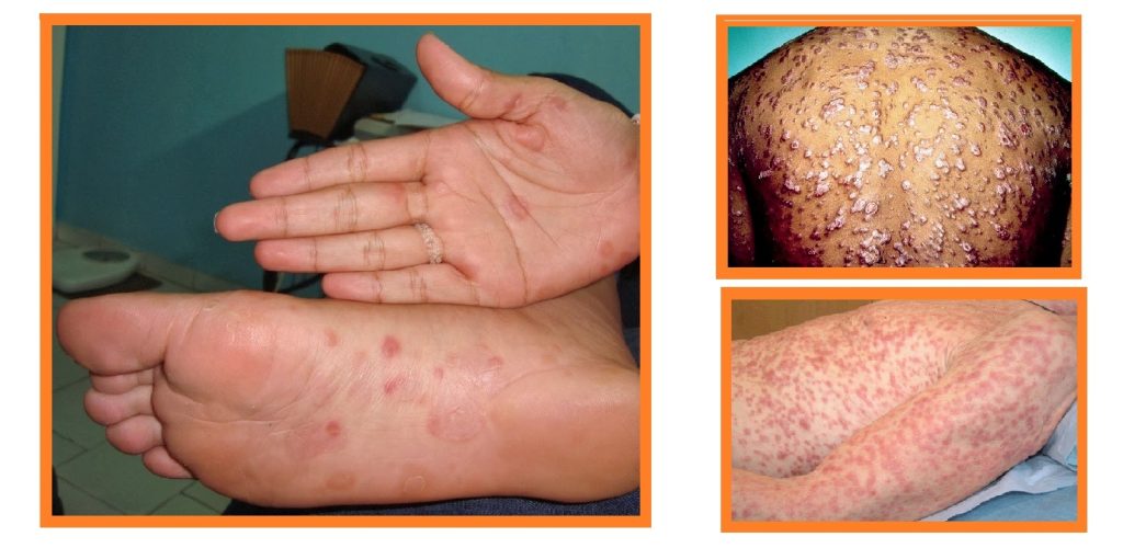 1. O que é o Cancro Duro e Como Identificá-lo? 2. Sífilis Primária: Os Primeiros Sinais e Sintomas. 3. A Importância do Teste Rápido de Sífilis no SUS. 4. Sífilis: Mitos e Verdades sobre a Ferida. 5. Quando a Ferida da Sífilis Desaparece: O Que Isso Significa?