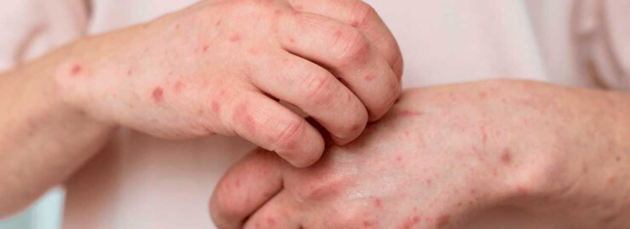 é a ferida da sífilis feminina