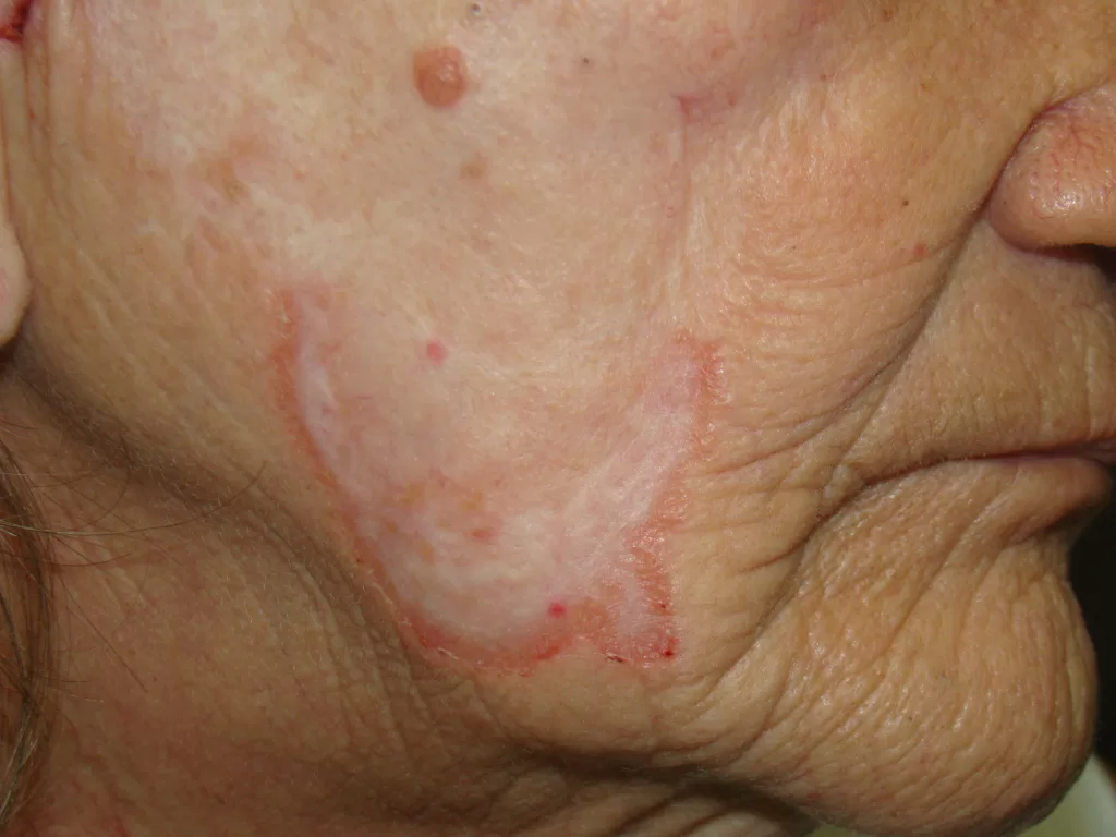 1. O que é o Cancro Duro e Como Identificá-lo? 2. Sífilis Primária: Os Primeiros Sinais e Sintomas. 3. A Importância do Teste Rápido de Sífilis no SUS. 4. Sífilis: Mitos e Verdades sobre a Ferida. 5. Quando a Ferida da Sífilis Desaparece: O Que Isso Significa?