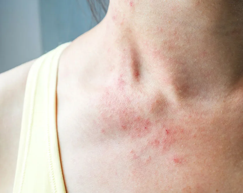 1. O que é o Cancro Duro e Como Identificá-lo? 2. Sífilis Primária: Os Primeiros Sinais e Sintomas. 3. A Importância do Teste Rápido de Sífilis no SUS. 4. Sífilis: Mitos e Verdades sobre a Ferida. 5. Quando a Ferida da Sífilis Desaparece: O Que Isso Significa?