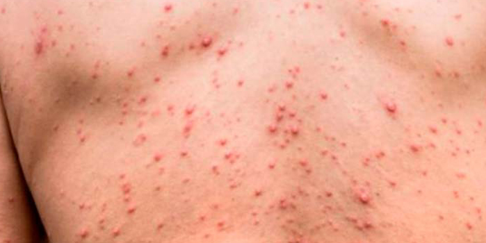 é a ferida da sífilis feminina