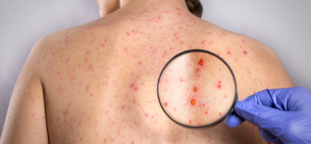 é a ferida da sífilis feminina