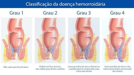 Como Aliviar a Dor e o Desconforto das Hemorroidas em Casa
