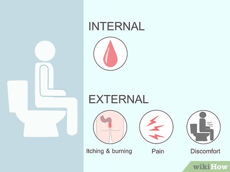 Guia Completo: Tratamentos Médicos e Cirúrgicos para Hemorroidas