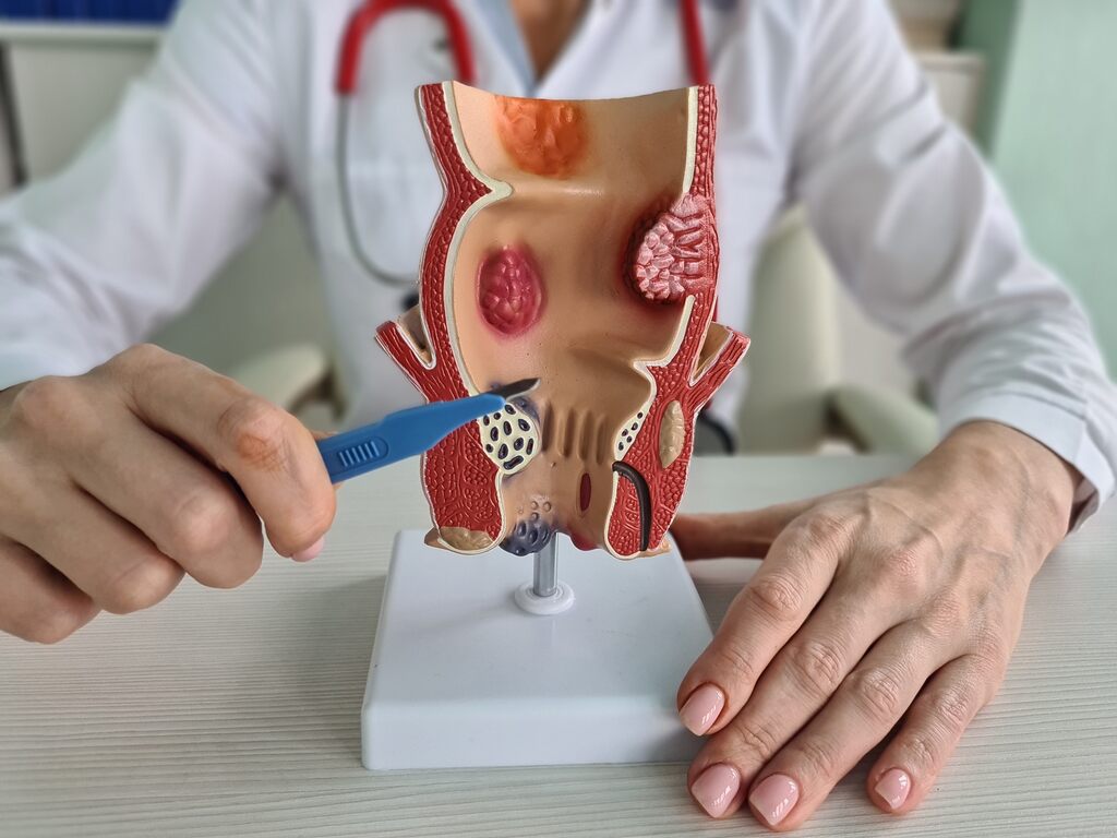 Dieta e Estilo de Vida: Aliados Essenciais no Tratamento de Hemorroidas