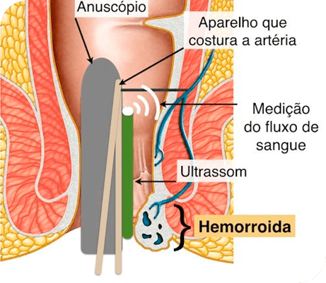 Hemorroidas: Entendendo os Tipos e as Melhores Abordagens de Tratamento