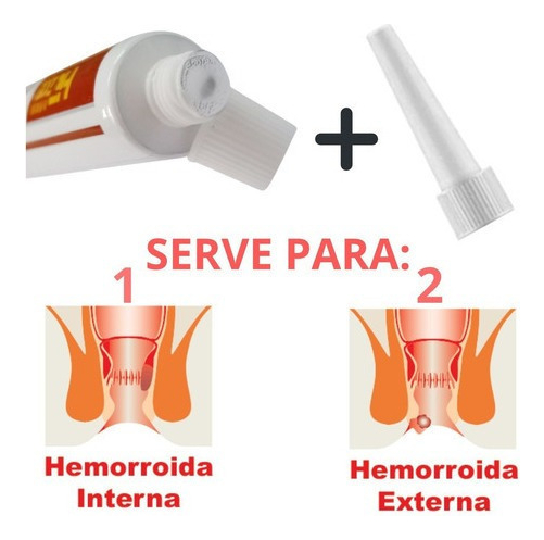 Hemorroidas: Entendendo os Tipos e as Melhores Abordagens de Tratamento