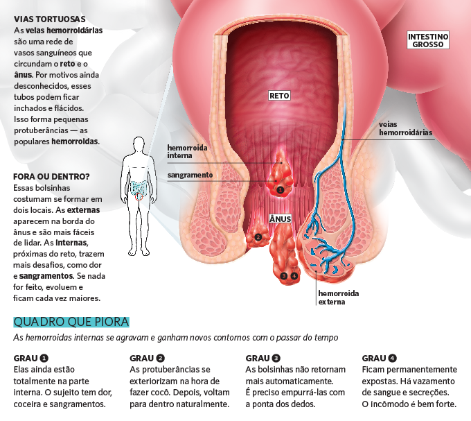 Medicamentos para Hemorroidas: Opções e Cuidados Essenciais